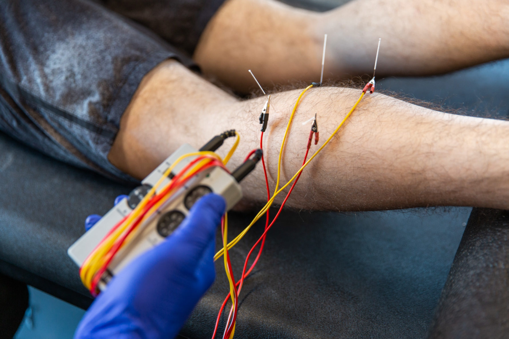 Standardized 8-point protocol of electrical dry needling for PF.