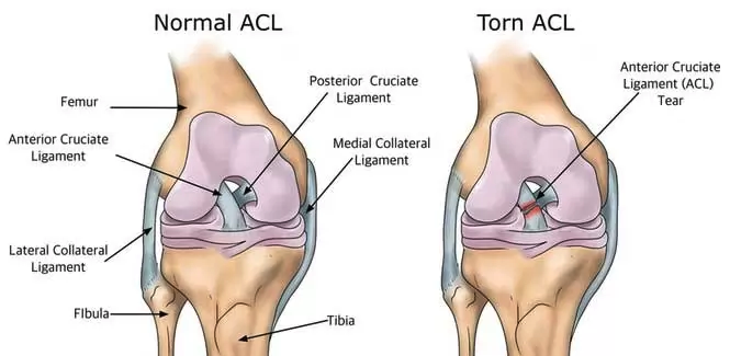 what does an acl injury look like? how to prevent an acl injury in kansas city